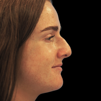 ultrasonic-rhinoplasty-before